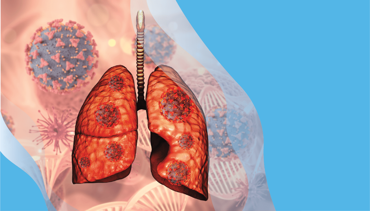 lung cancer